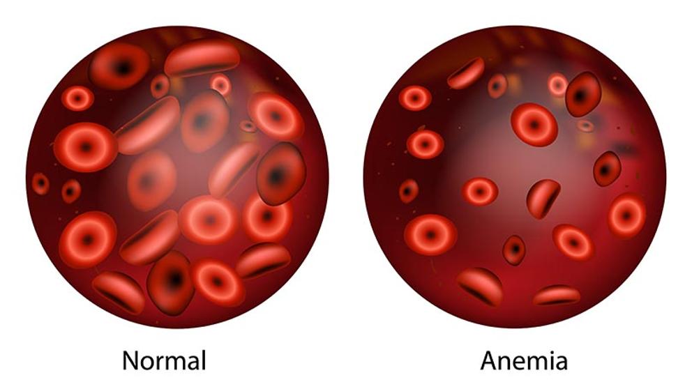 Anemia - RS Bhayangkara Balikpapan