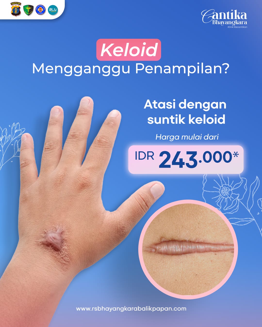 Terapi Keloid